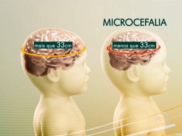 Microcefalia 7997